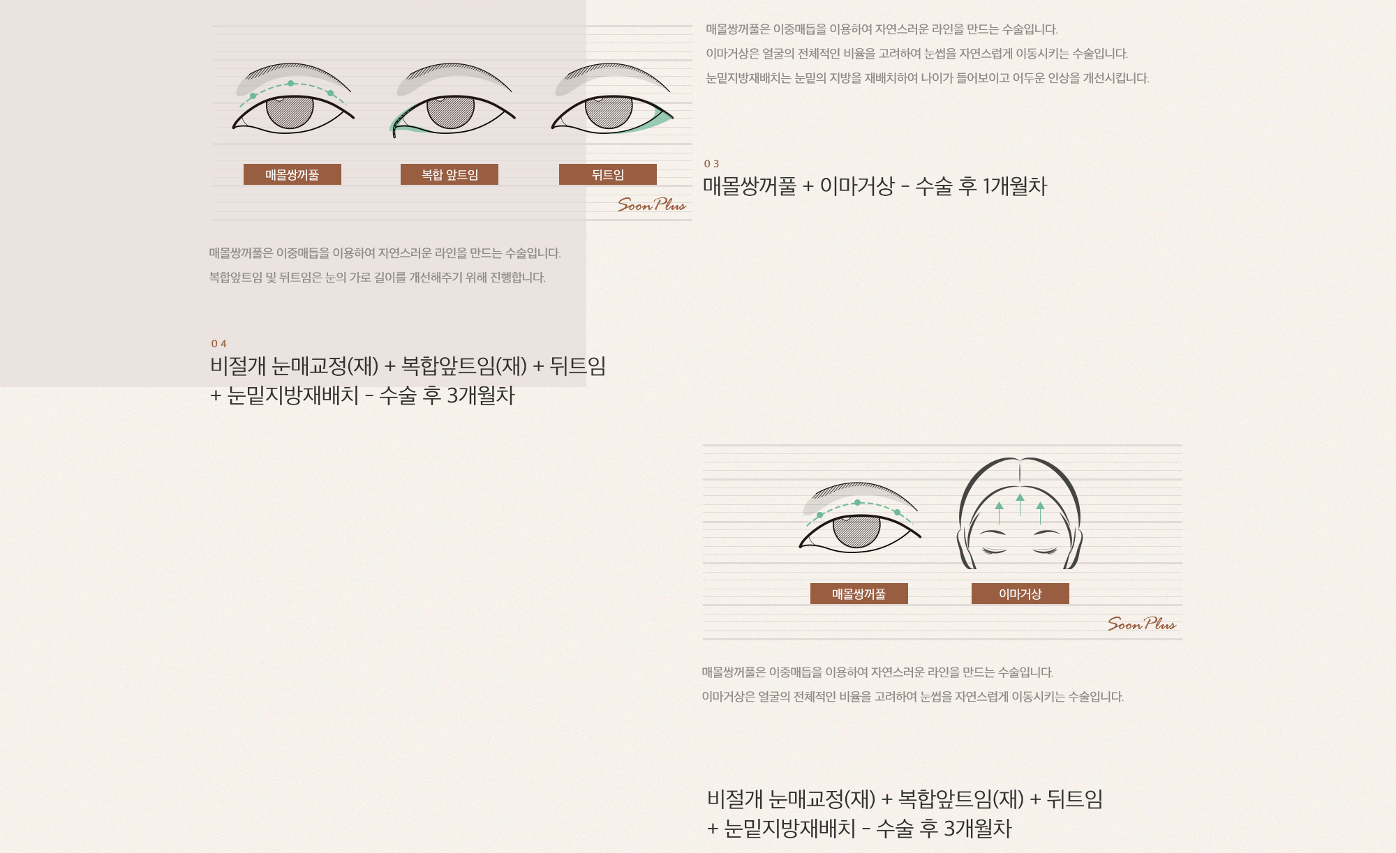 매몰쌍꺼풀은 이중매듭을 이용하여 자연스러운 라인을 만드는 수술입니다.