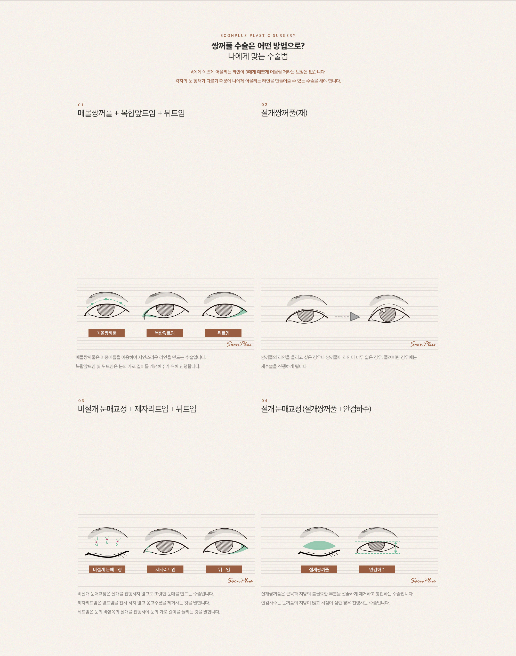나에게 맞는 수술법