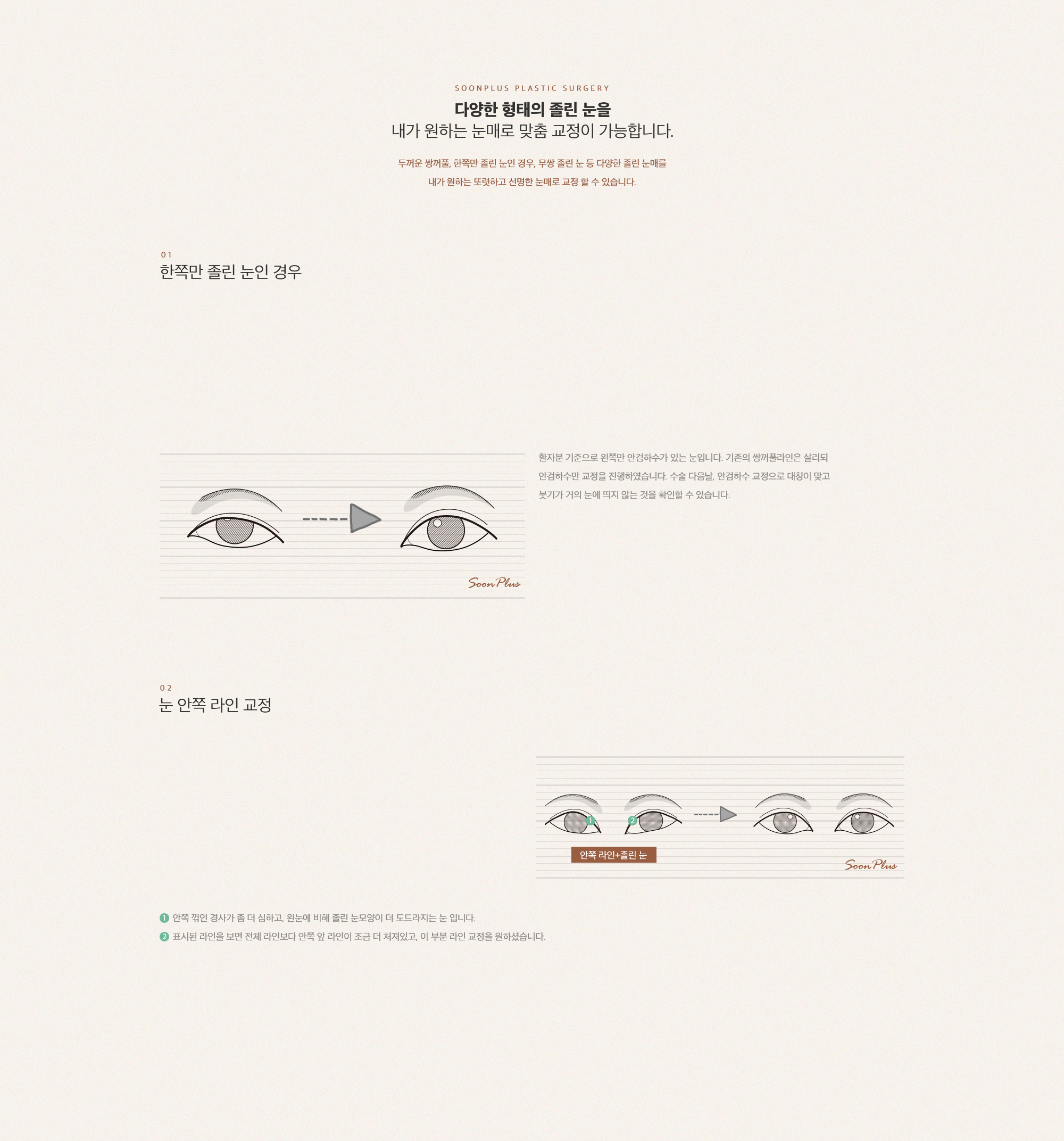 1day 눈매교정 케이스 1
