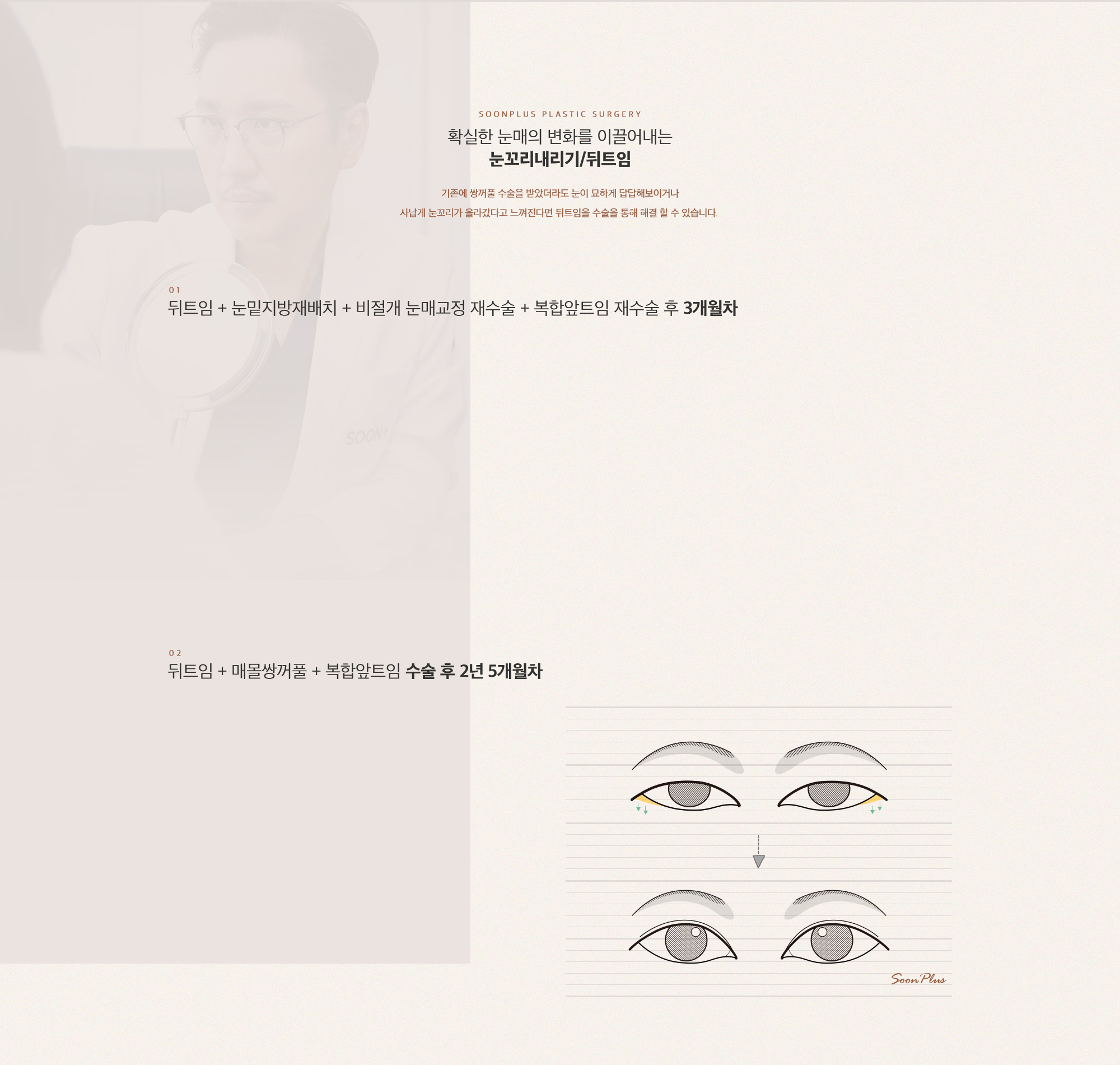 확실한 눈매의 변화를 이끌어내는 눈꼬리내리기/뒤트임