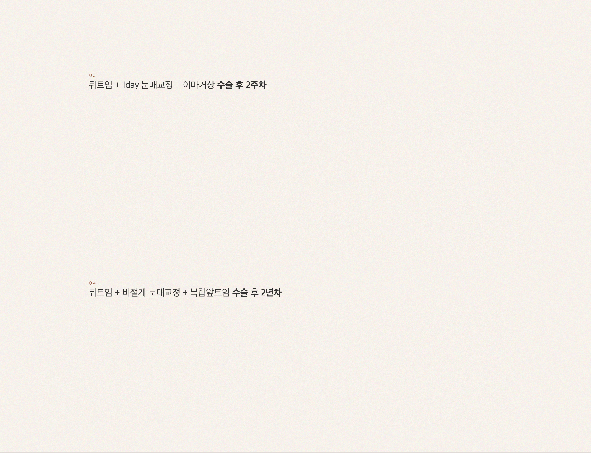 기존에 쌍꺼풀 수술을 받았더라도 눈이 묘하게 답답해보이거나 사납게 눈꼬리가 올라갔다고 느껴진다면 뒤트임을 수술을 통해 해결 할 수 있습니다.
