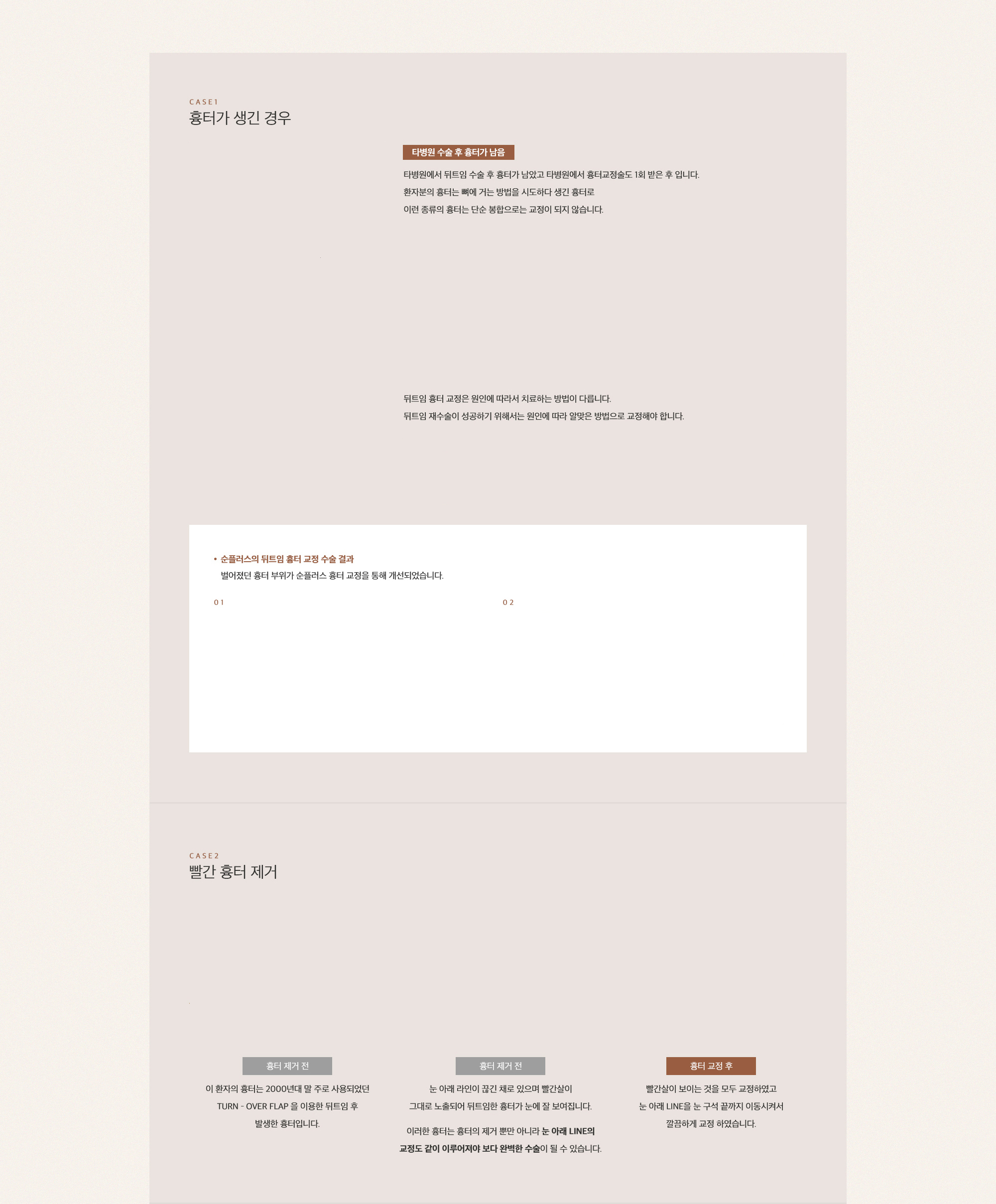 뒤트임 재수술은 이미 흉터가 생긴 부위를 다시 재수술하는 것이기 때문에 어설프게 수술했다간 새로운 흉터가 발생할 수 있으므로 의료진의 실력이 무엇보다 중요합니다.