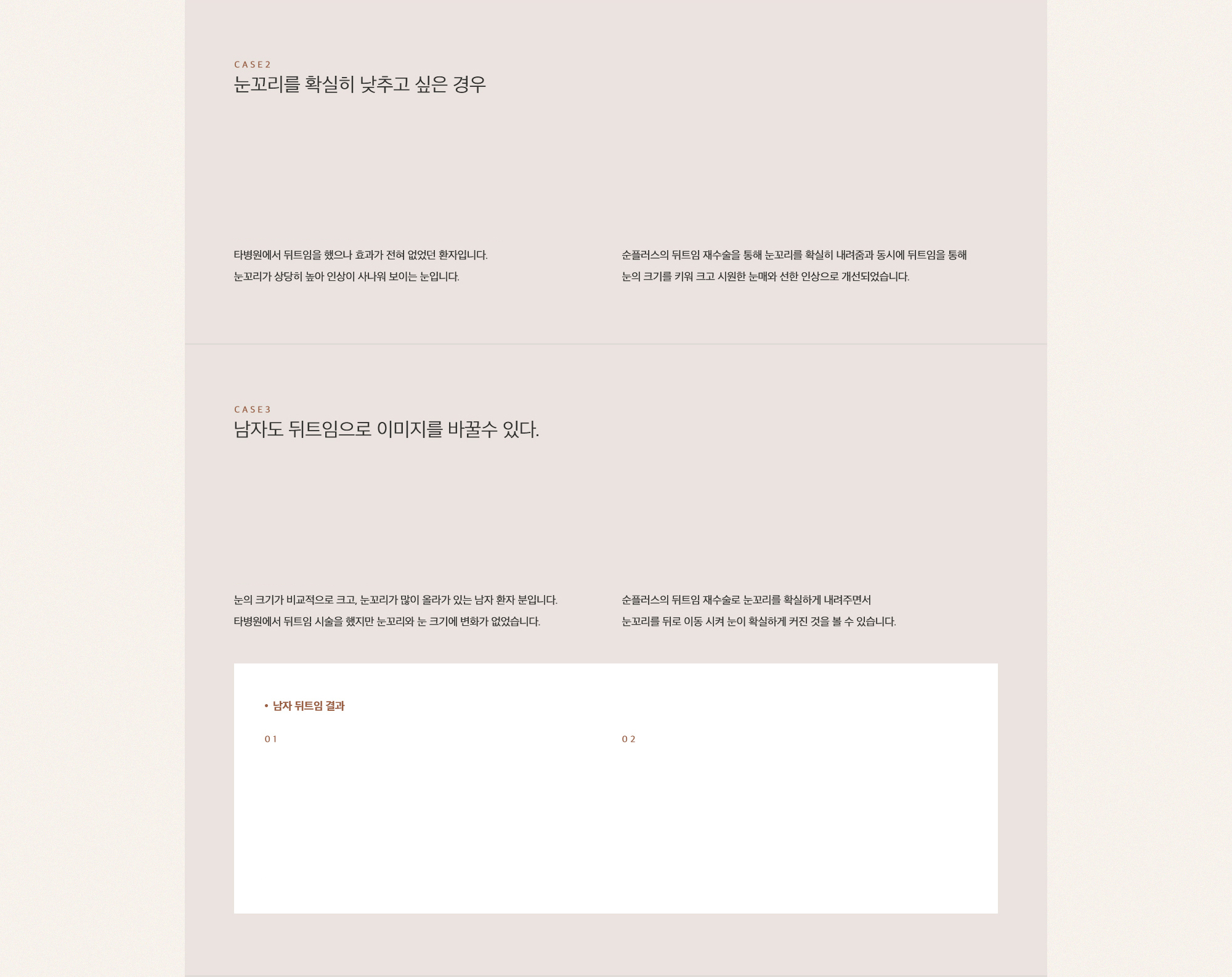 뒤트임 재수술은 이미 수술을 받았던 부위를 재수술 하기 때문에 첫수술보다 난이도가 높습니다.