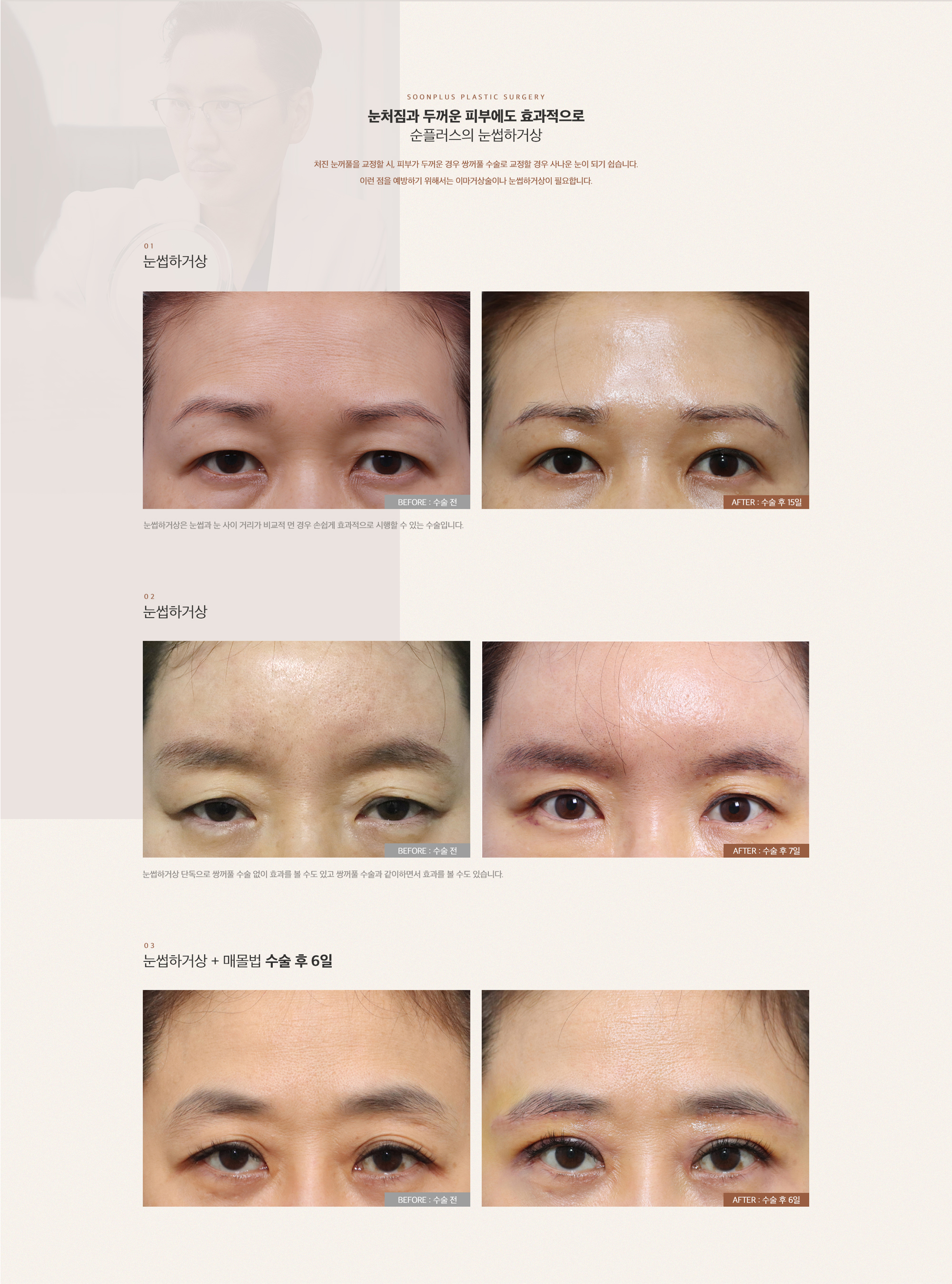 눈처짐과 두꺼운 피부에도 효과적으로 순플러스의 눈썹거상술