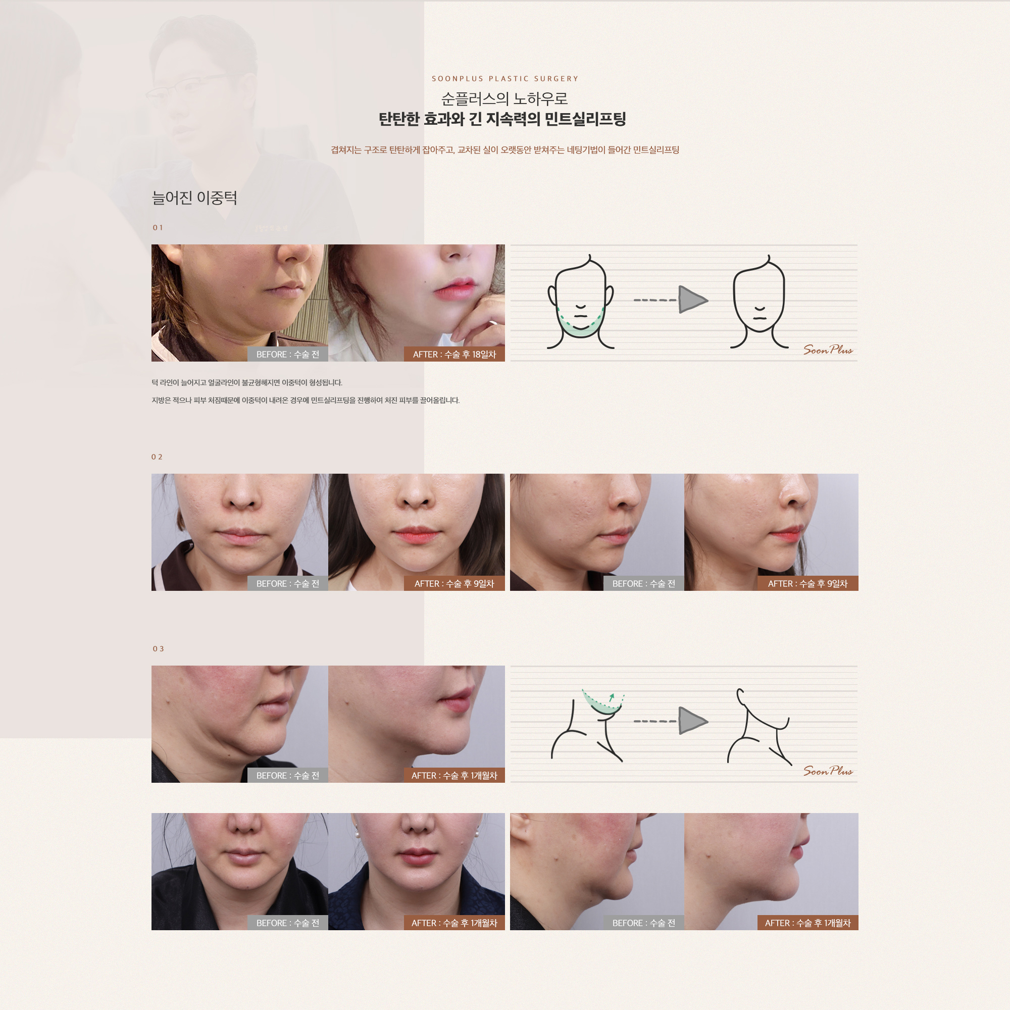순플러스의 노하우로 탄탄한 효과와 긴 지속력의 민트실리프팅