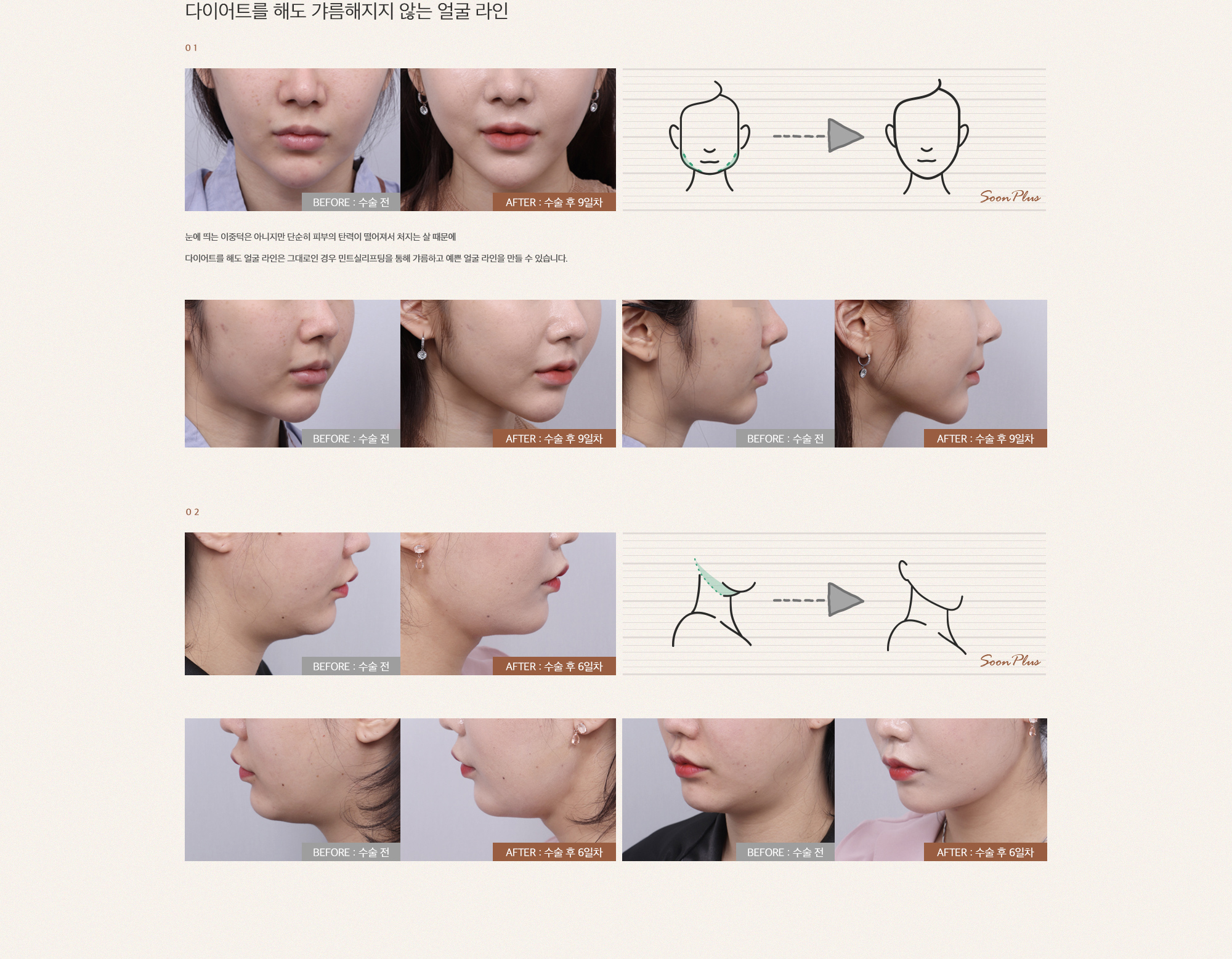 겹쳐지는 구조로 탄탄하게 잡아주고, 교차된 실이 오랫동안 받쳐주는 네팅기법이 들어간 민트실리프팅