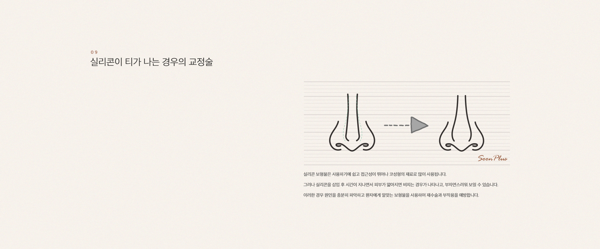 코 재수술