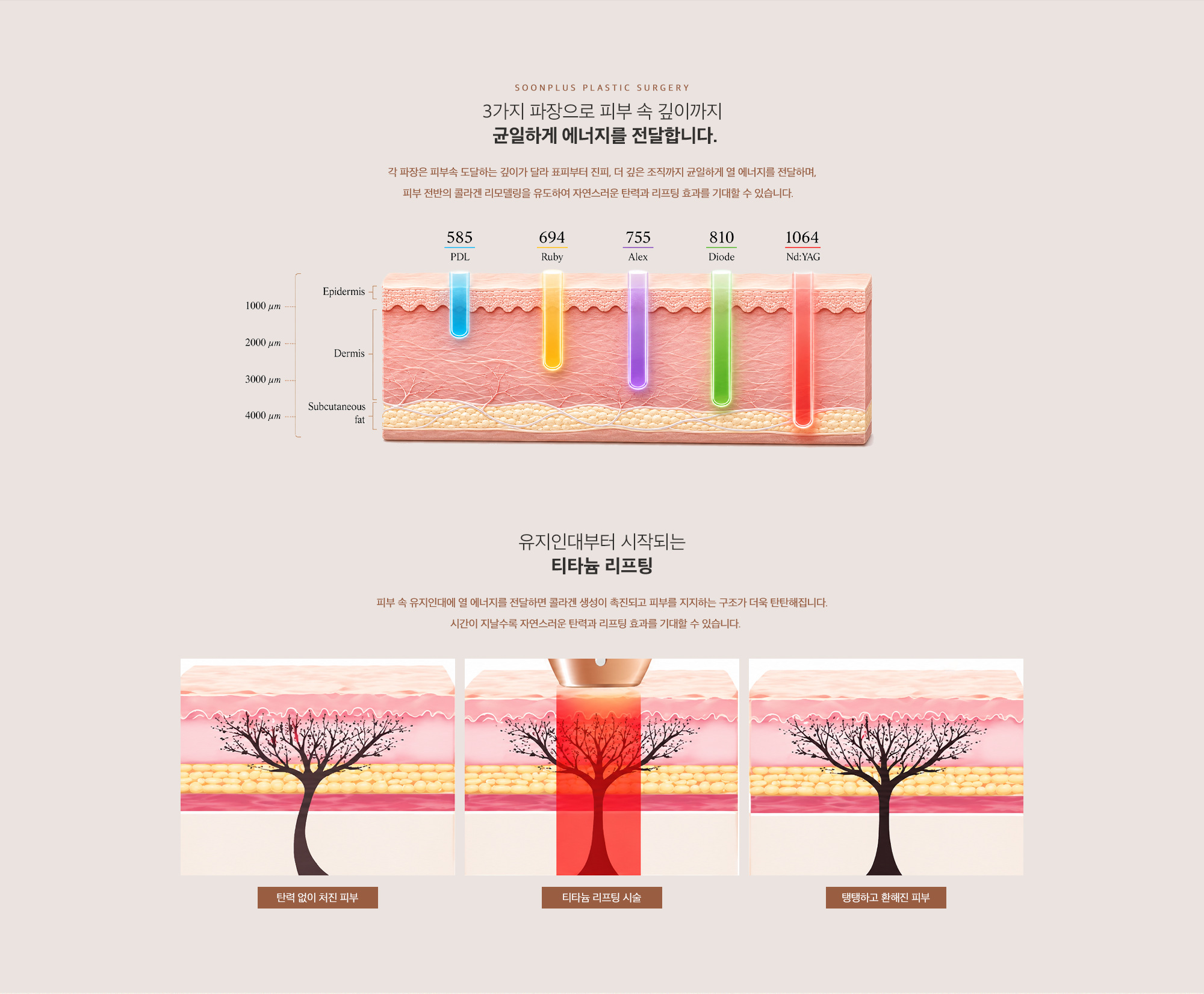 순플러스 티타늄레이저 — 에너지 전달과 피부 변화